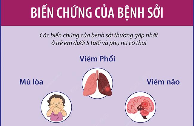 5 khuyến cáo của Bộ Y tế phòng chống bệnh Sởi
